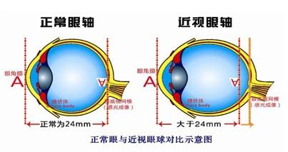 高度近视有什么危害