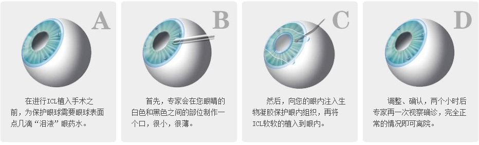 ICL眼内镜手术安全吗