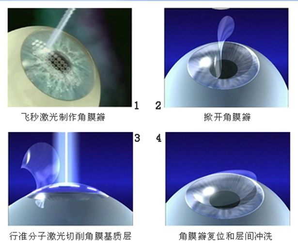 怎么提高眼睛视力